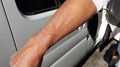 Close-up of a forearm with severely dry, flaky skin resting against a gray car door.